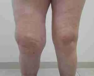 Tratamiento de la Gonartrosis