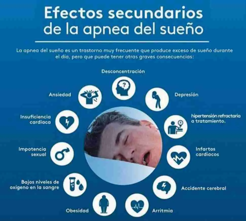 Apnea obstructiva del sueño