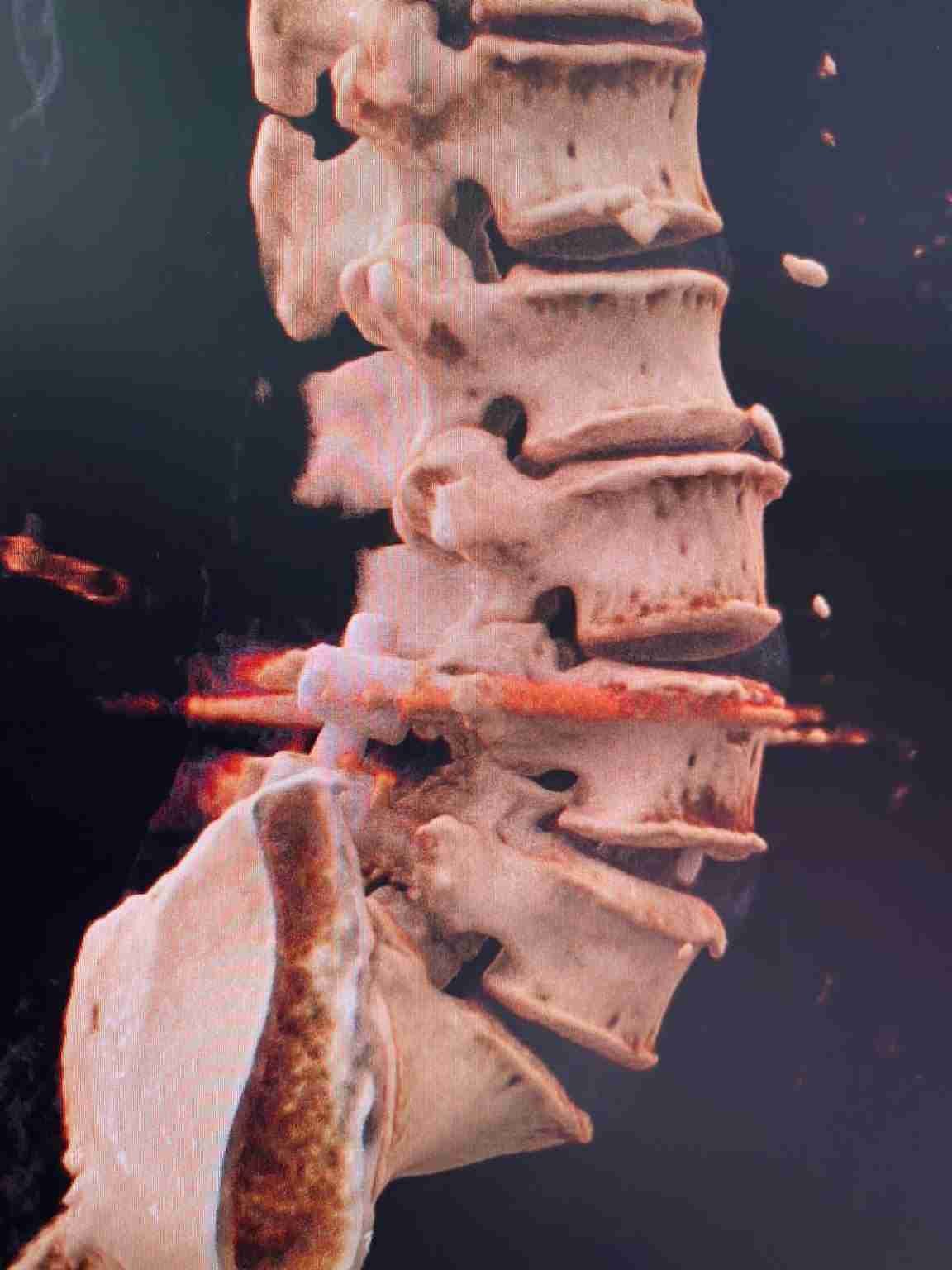 Dolor de espalda baja en adultos mayores