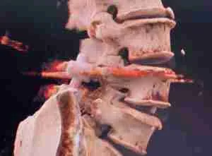 Dolor de espalda baja en adultos mayores