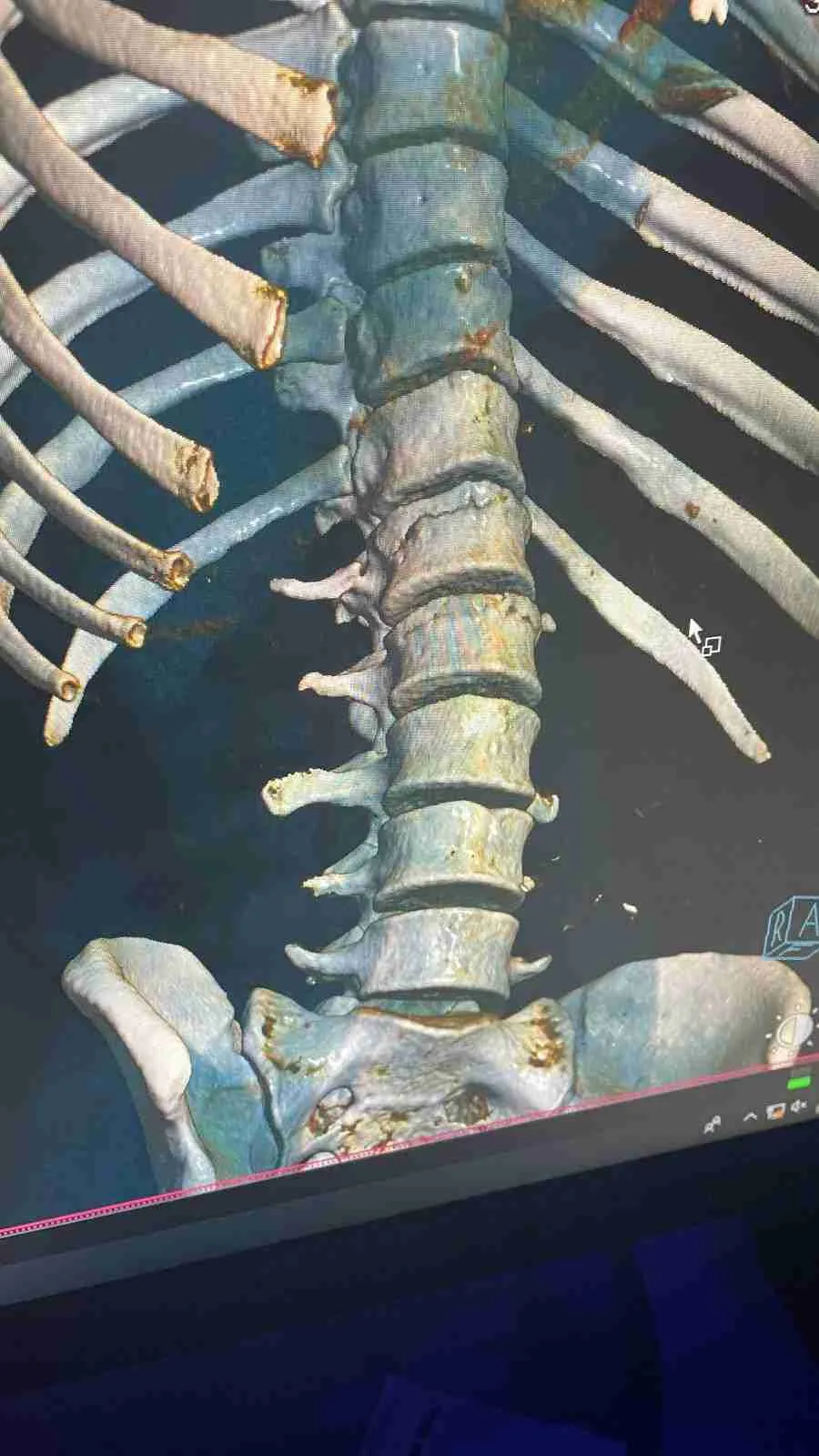 Dolor de espalda baja en adultos mayores